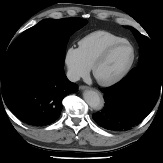 Aortic intramural hematoma (type B) (Radiopaedia 79323-92387 Axial C+ delayed 40).jpg