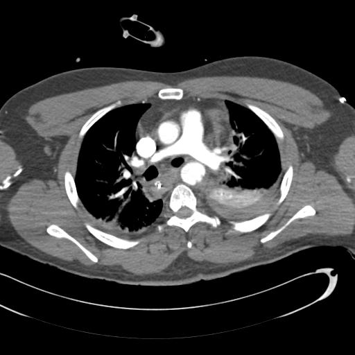 Aortic transection, diaphragmatic rupture and hemoperitoneum in a complex multitrauma patient (Radiopaedia 31701-32622 A 36).jpg