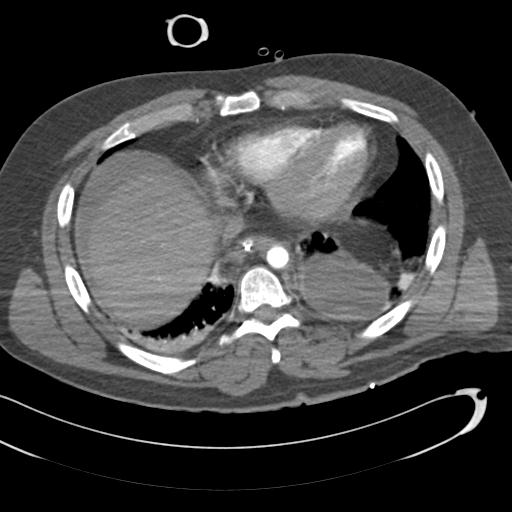 Aortic transection, diaphragmatic rupture and hemoperitoneum in a complex multitrauma patient (Radiopaedia 31701-32622 A 62).jpg