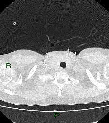 File:Aortic valve endocarditis (Radiopaedia 87209-103485 Axial lung window 10).jpg