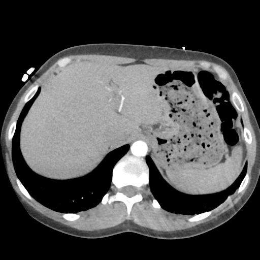 Aortic valve non-coronary cusp thrombus (Radiopaedia 55661-62189 B 47).png