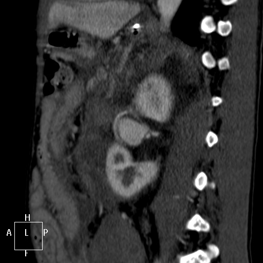 Aorto-left renal vein fistula (Radiopaedia 45534-49628 C 46).jpg