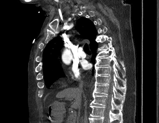 Aortoesophageal fistula with endovascular repair (Radiopaedia 73781-84592 Sagittal C+ CTPA 86).jpg