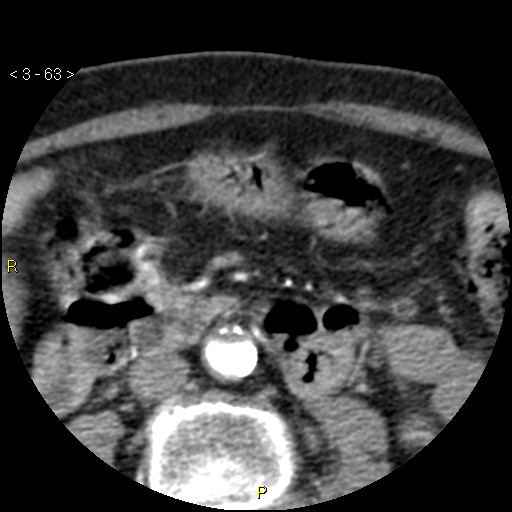File:Aortoiliac occlusive disease (Radiopaedia 16828-16548 A 63).jpg