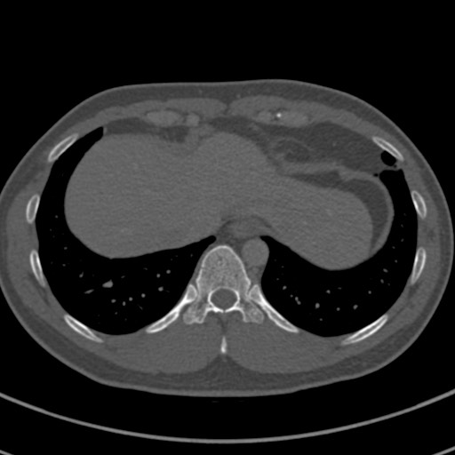 Apical lung mass mimic - neurogenic tumor (Radiopaedia 59918-67521 Axial bone window 68).jpg
