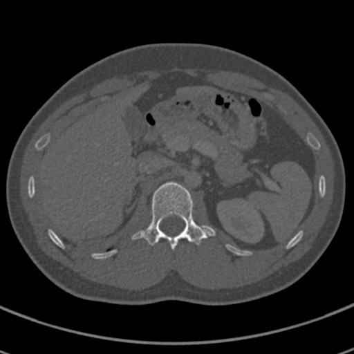 Apical lung mass mimic - neurogenic tumor (Radiopaedia 59918-67521 Axial bone window 87).jpg