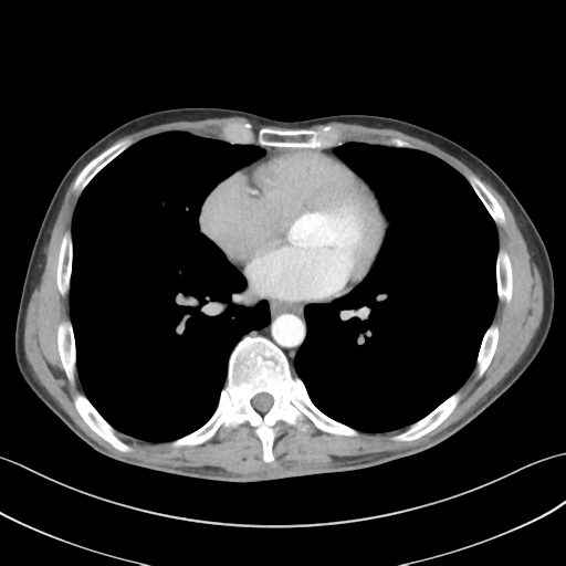 File:Apical pleural calcification (Radiopaedia 46141-50499 Axial C+ delayed 43).png