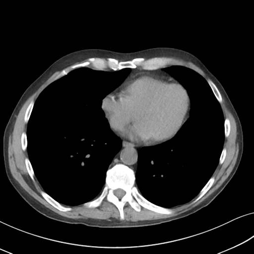 Apical pulmonary metastasis (Radiopaedia 46338-50754 B 43).png