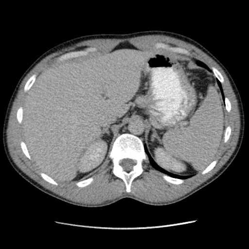 File:Appendicitis complicated by post-operative collection (Radiopaedia 35595-37113 A 13).jpg
