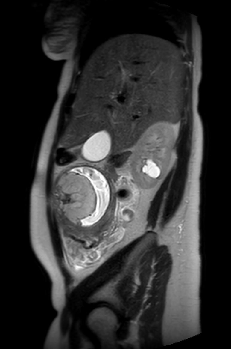 Appendicitis in gravida (MRI) (Radiopaedia 89433-106395 Sagittal T2 49).jpg