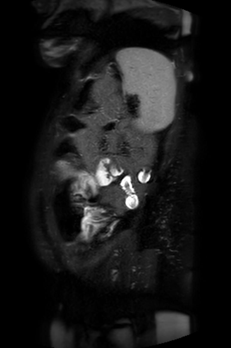 Appendicitis in gravida (MRI) (Radiopaedia 89433-106395 Sagittal T2 SPAIR 11).jpg
