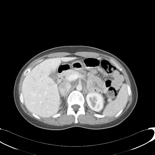 File:Appendicitis with minimal stranding but appendicolith (Radiopaedia 29035-29397 A 25).jpg