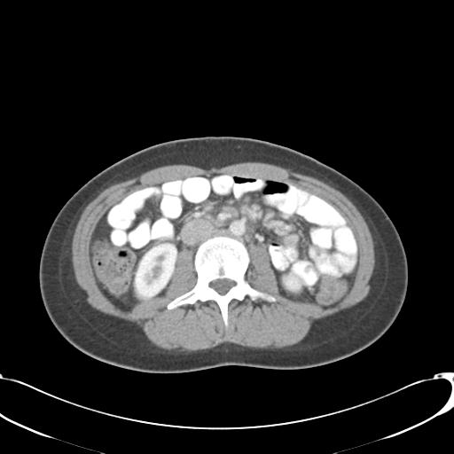 Appendicitis with minimal stranding but appendicolith (Radiopaedia 29035-29397 A 41).jpg