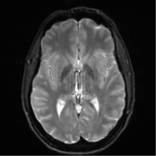 Arachnoid cyst - cerebellopontine angle (Radiopaedia 59689-67083 Axial DWI 18).png