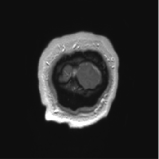 File:Arachnoid cyst with subdural hematoma (Radiopaedia 85892-101743 Coronal T1 C+ 1).png