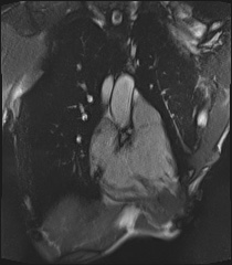 Arrhythmogenic right ventricular cardiomyopathy (Radiopaedia 57972-64966 CINE R2 SSFP 92).jpg