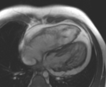 Arrhythmogenic right ventricular cardiomyopathy (Radiopaedia 69431-79307 4ch cine 16).jpg