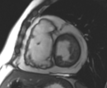 Arrhythmogenic right ventricular cardiomyopathy (Radiopaedia 69431-79307 Short axis cine 133).jpg
