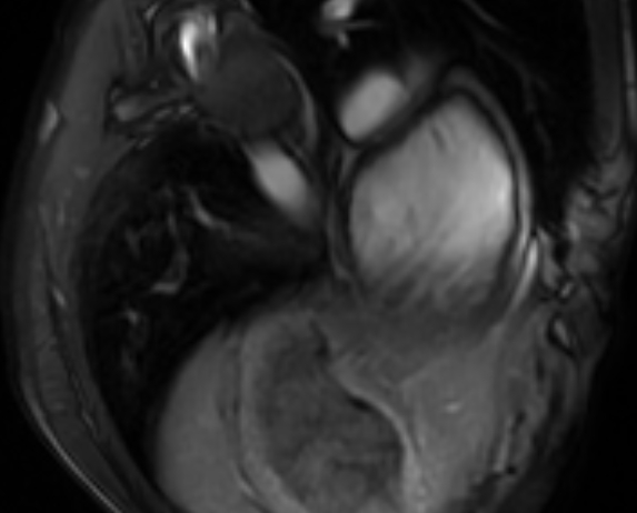 File:Arrhythmogenic right ventricular cardiomyopathy (Radiopaedia 69564-79464 4ch cine 157).jpg