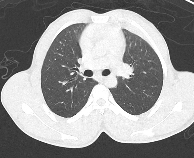 Arrow injury to the chest (Radiopaedia 75223-86321 Axial lung window 27).jpg