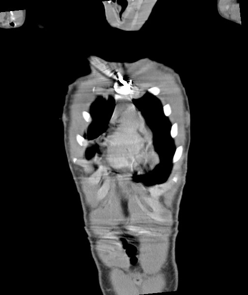 Arrow injury to the chest (Radiopaedia 85367-100975 F 42).jpg