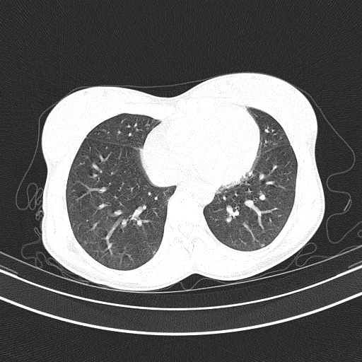 Arteria lusoria (Radiopaedia 88528-105192 Axial lung window 44).jpg