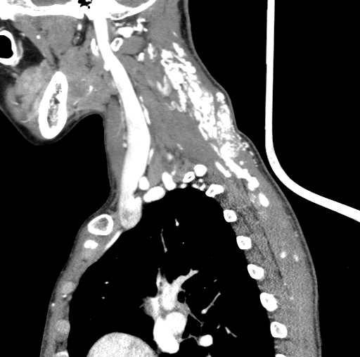 Arteriovenous malformation of the neck (Radiopaedia 53935-60062 C 35).jpg