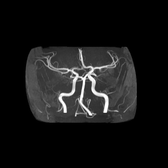 Artery of Percheron infarct (Radiopaedia 40966-43676 F 4).jpg