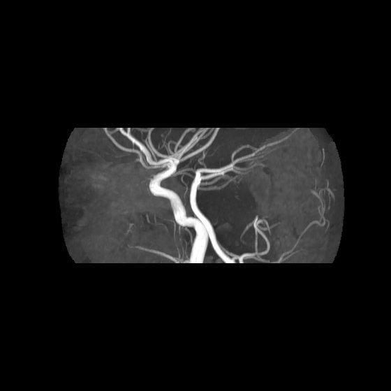 File:Artery of Percheron infarct (Radiopaedia 40966-43676 G 59).jpg