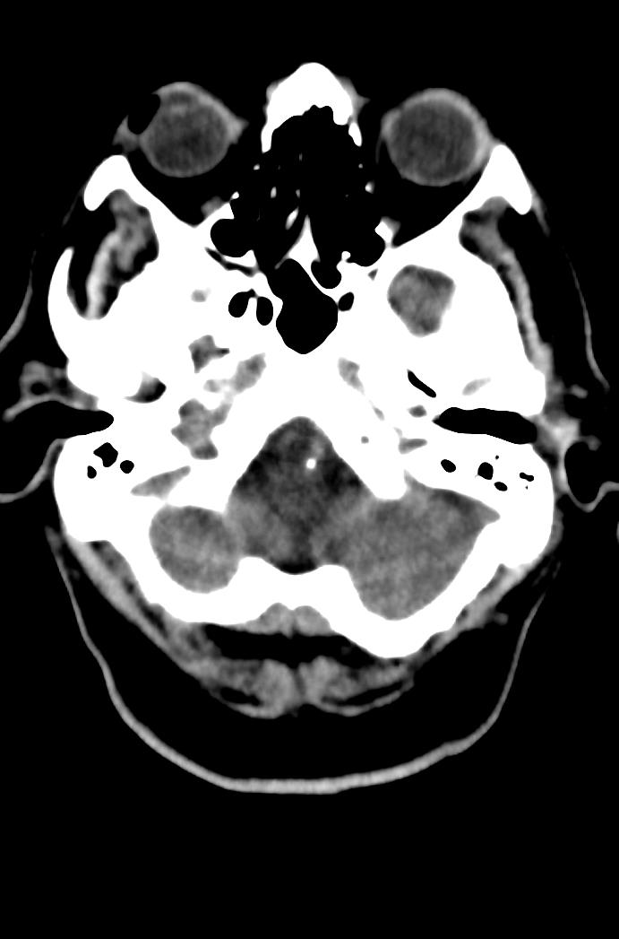 Artery of Percheron infarction (Radiopaedia 80613-94202 Axial non-contrast 38).jpg