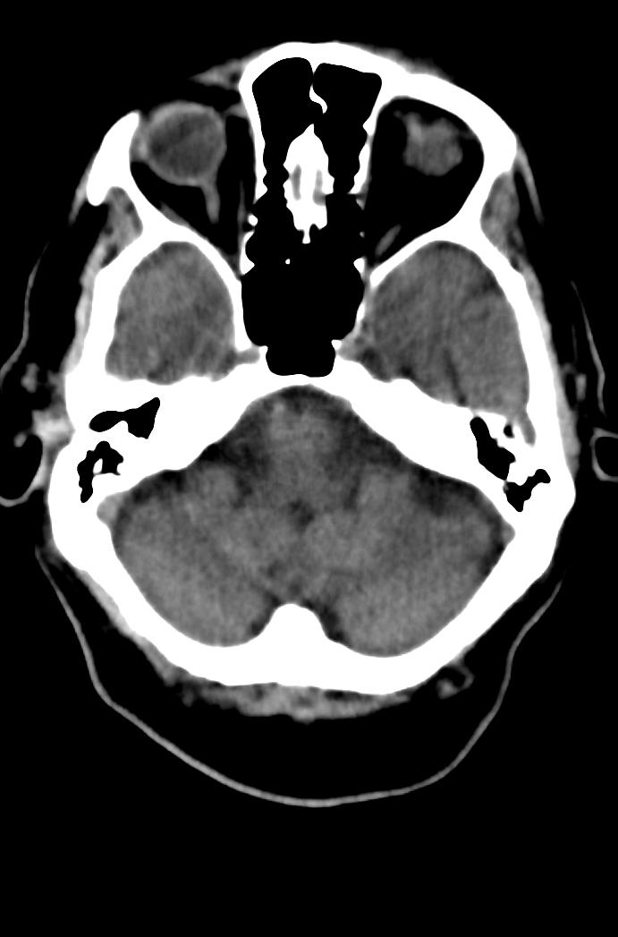 Artery of Percheron infarction (Radiopaedia 80613-94202 Axial non-contrast 51).jpg