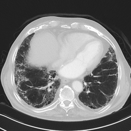File:Asbestosis (Radiopaedia 56192-62864 Axial lung window 44).png