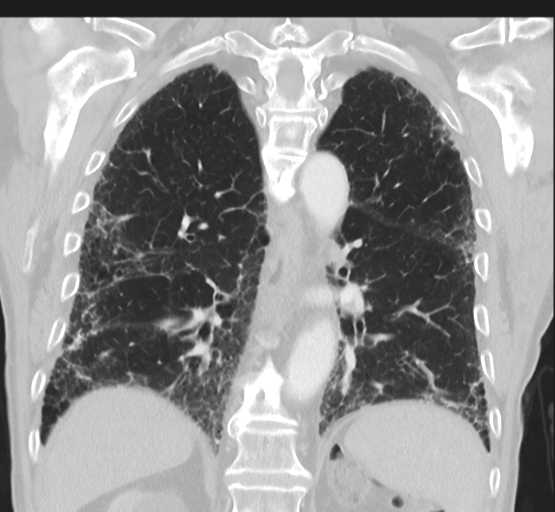File:Asbestosis (Radiopaedia 56192-62864 Coronal lung window 35).png