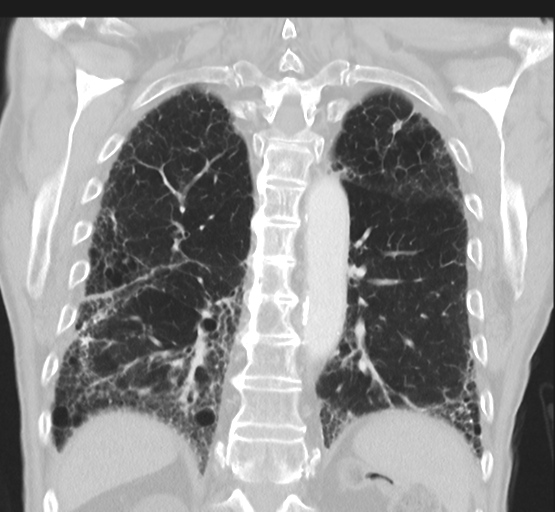 Asbestosis (Radiopaedia 56192-62864 Coronal lung window 38).png