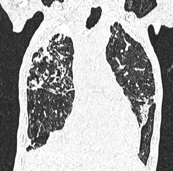 Aspergilloma- with Monod sign (Radiopaedia 44737-48532 Coronal lung window 202).jpg