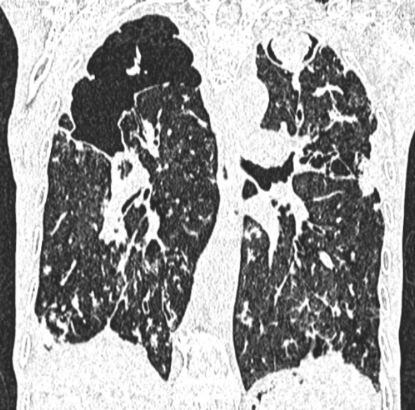 Aspergilloma- with Monod sign (Radiopaedia 44737-48532 Coronal lung window 283).jpg