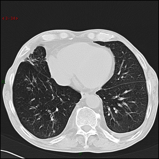 File:Aspergilloma (Radiopaedia 14842-14787 Axial lung window 34).jpg