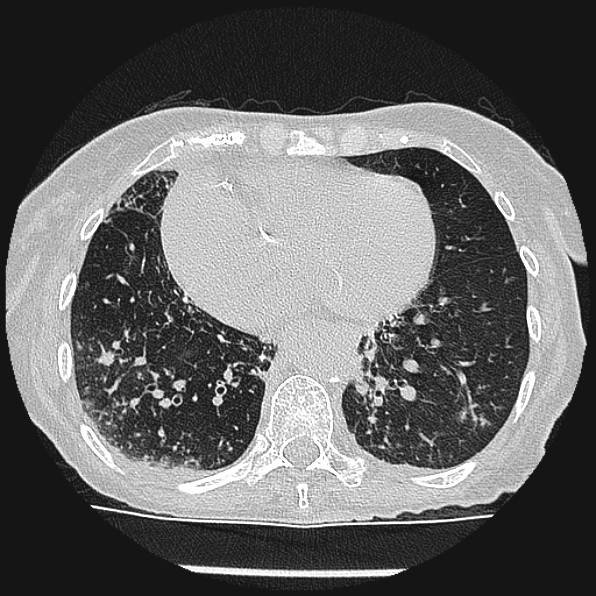 Aspergilloma (Radiopaedia 24458-24763 Axial lung window 48).jpg