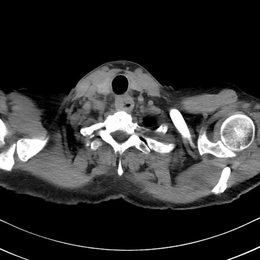File:Aspergilloma on background pulmonary fibrosis (Radiopaedia 60942-68757 Axial non-contrast 3).jpg