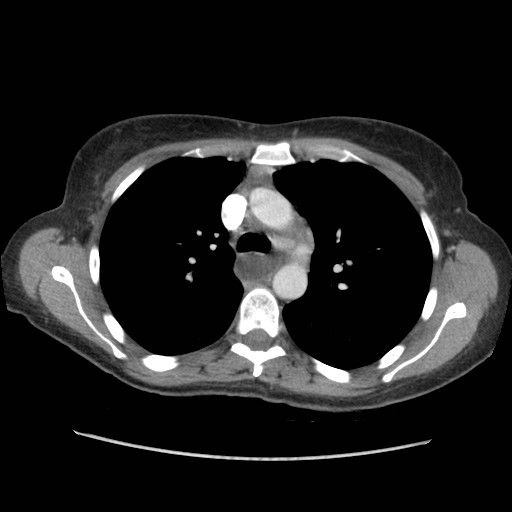 Aspiration pneumonia secondary to laparoscopic banding (Radiopaedia 18345-18183 A 16).jpg
