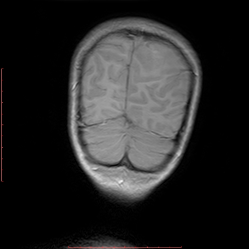 File:Astroblastoma (Radiopaedia 74287-85162 Coronal T1 21).jpg