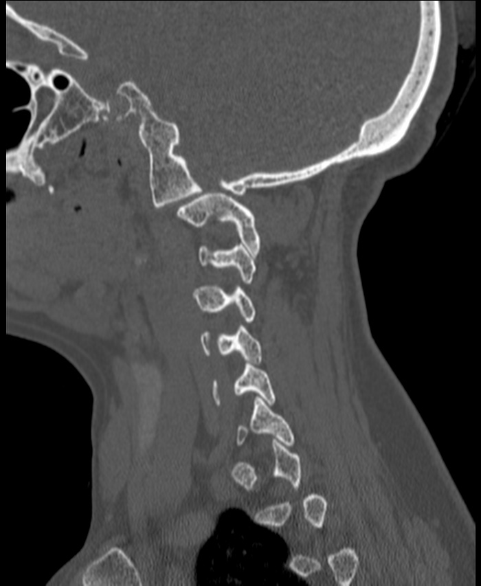 Atlanto-occipital assimilation with basilar invagination (Radiopaedia 70122-80188 Sagittal bone window 15).jpg