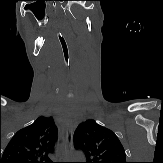 Atlanto-occipital dissociation (Traynelis type 1), C2 teardrop fracture, C6-7 facet joint dislocation (Radiopaedia 87655-104061 Coronal bone window 29).jpg