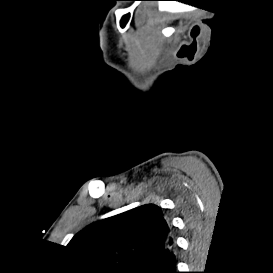 Atlanto-occipital dissociation (Traynelis type 1), C2 teardrop fracture, C6-7 facet joint dislocation (Radiopaedia 87655-104061 D 10).jpg
