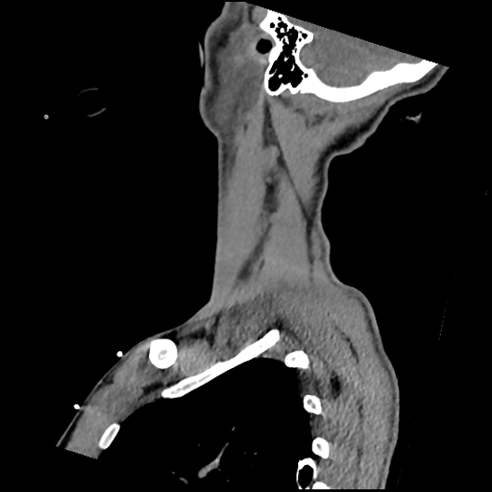 Atlanto-occipital dissociation (Traynelis type 1), C2 teardrop fracture, C6-7 facet joint dislocation (Radiopaedia 87655-104061 D 71).jpg