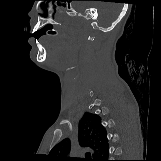 File:Atlanto-occipital dissociation (Traynelis type 1), C2 teardrop fracture, C6-7 facet joint dislocation (Radiopaedia 87655-104061 Sagittal bone window 21).jpg