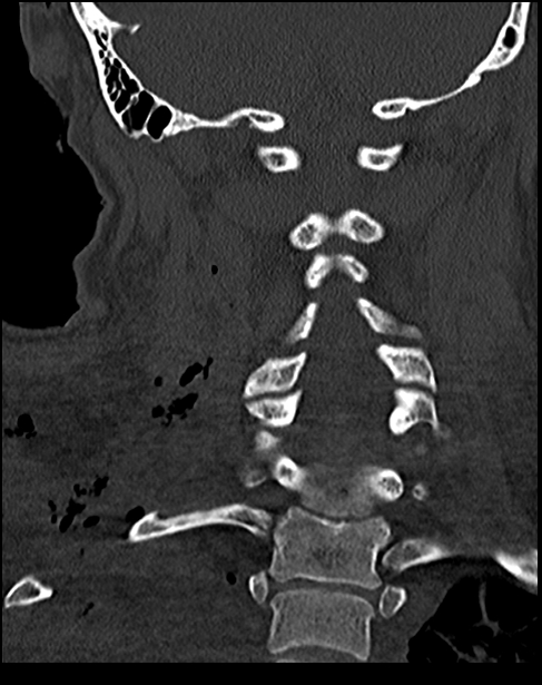 Atlanto-occipital dissociation - Traynelis type 1 (Radiopaedia 87570-103948 Coronal bone window 39).jpg