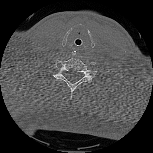 Atlanto-occipital dissociation injury (Radiopaedia 29274-29698 Axial bone window 56).png