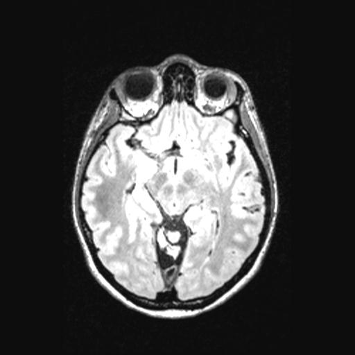 Atretic encephalocoele with inferior vermis hypoplasia (Radiopaedia 30443-31108 Axial 71).jpg