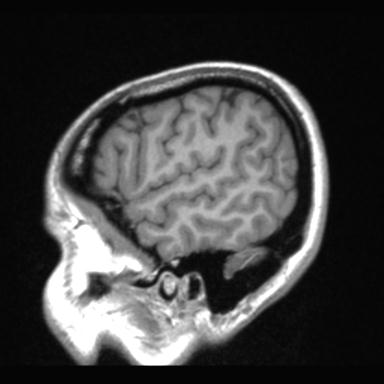 Atretic encephalocoele with inferior vermis hypoplasia (Radiopaedia 30443-31108 Sagittal T1 16).jpg